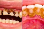 Cavity Removal Tips